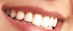 implantes-dentarios-itaguai-1367939592